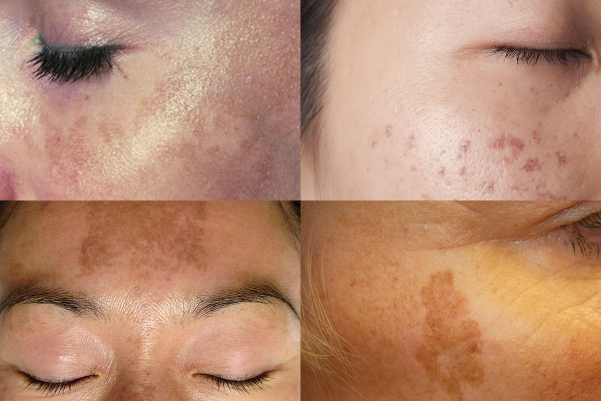 Photo showing the 4 types of pigmentation