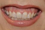 Lips showing gummy smile