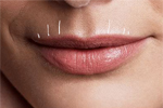 Lips showing upper lip lines