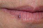 Lips showing venous lake blemish